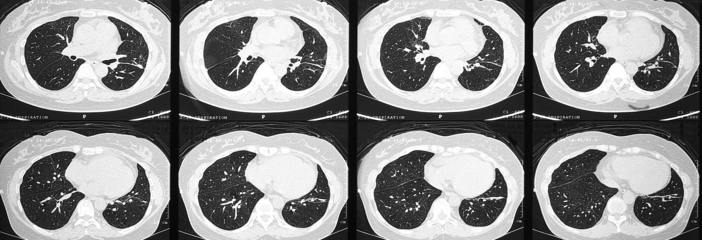 Rare Case of Gaucher Disease with Lung Damage Seen in Young Child