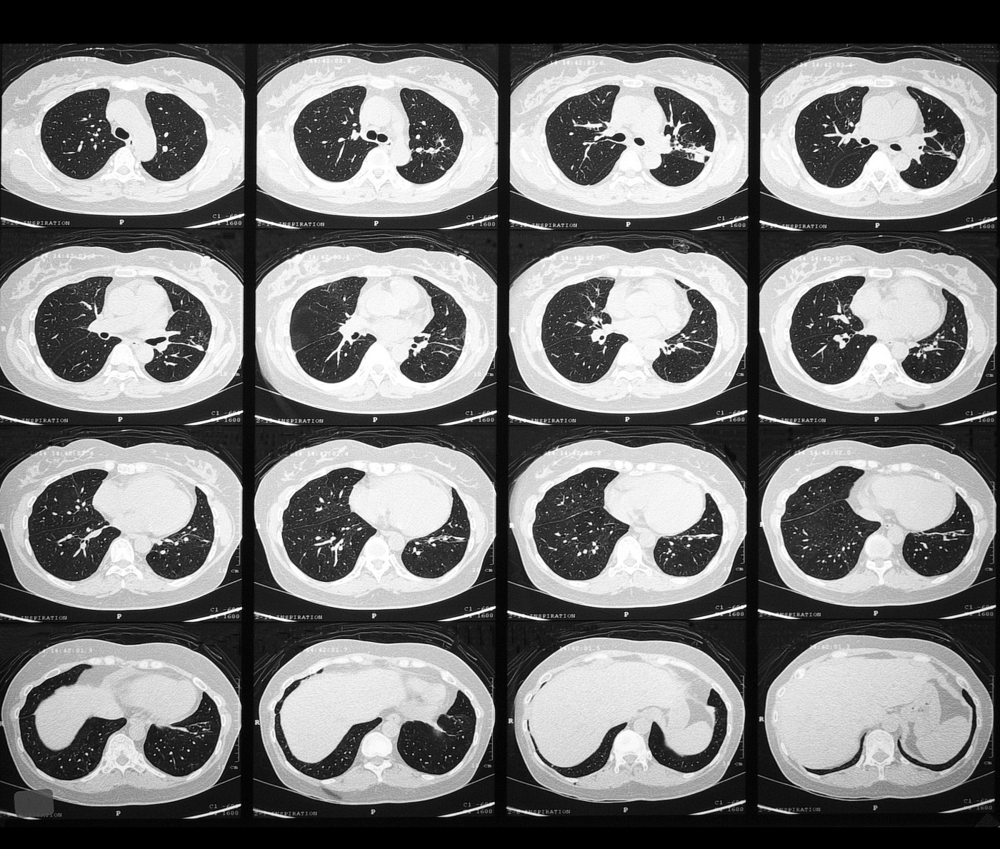 A lung high-resolution computed tomography (HRCT) scan might reveal how Gaucher disease affects the lungs.