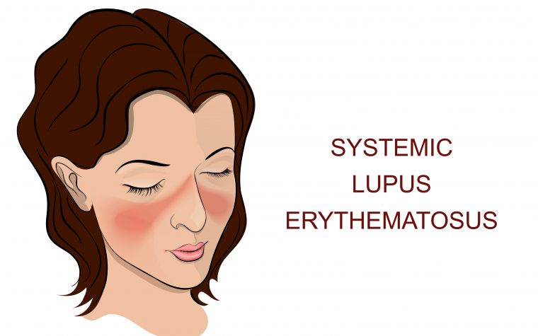 Gaucher disease link to lupus