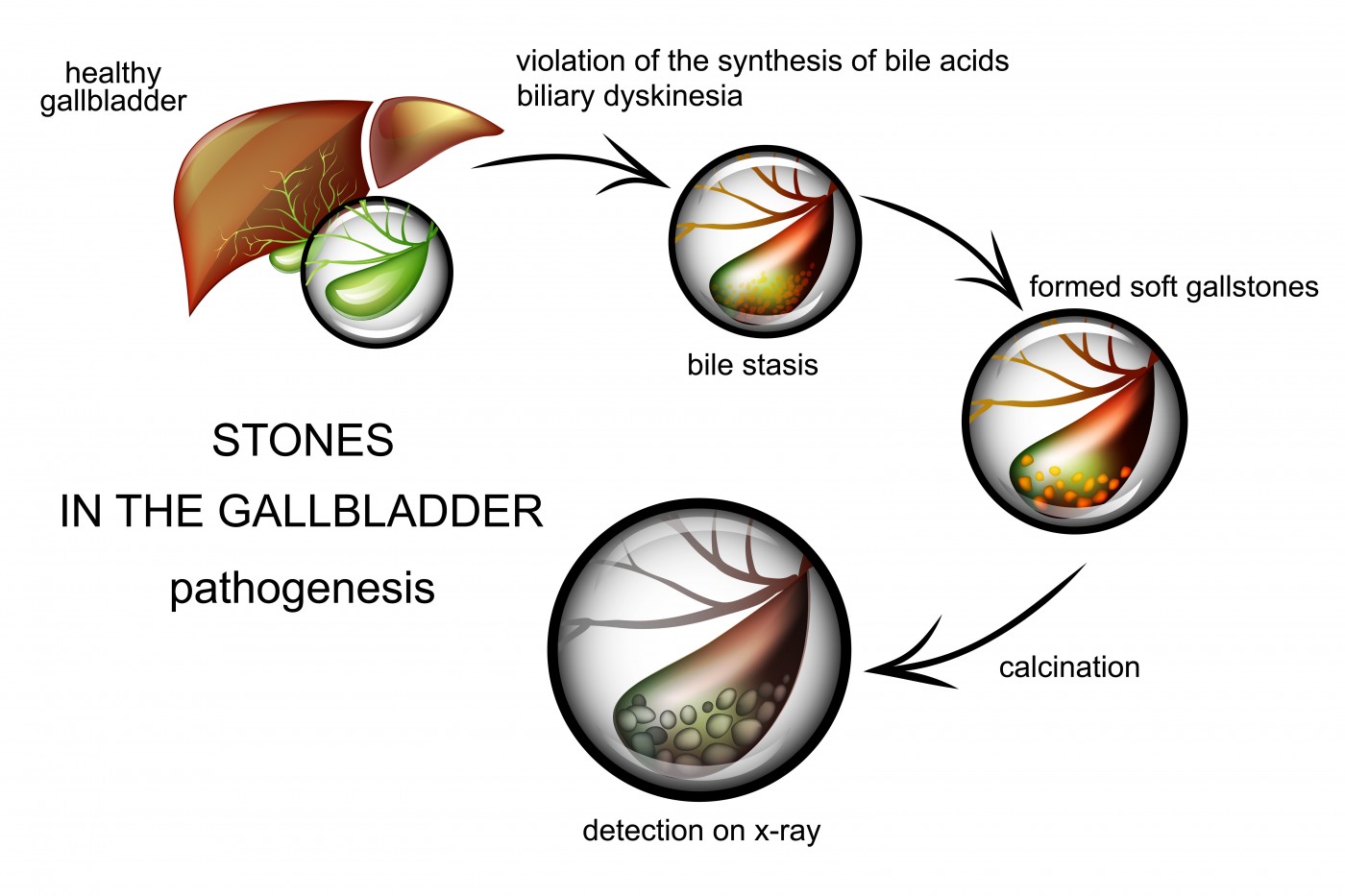 Gaucher Type 1 Case Study Calls Attention to Gallbladder Stones