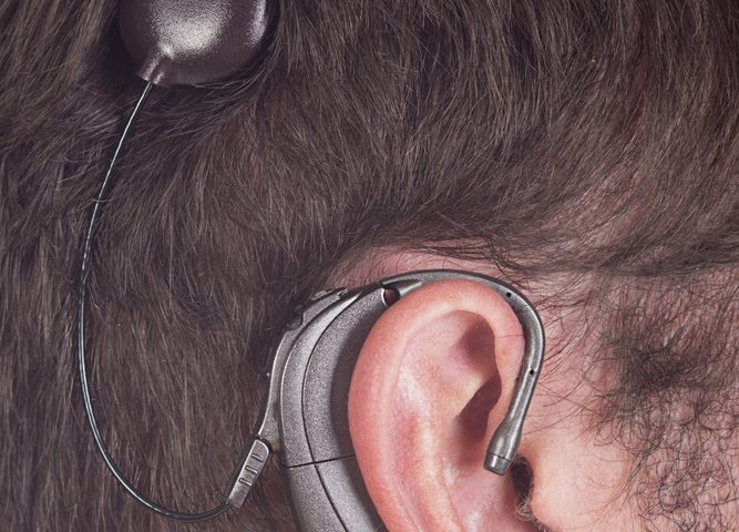 Hearing Loss in Gaucher Disease Type 1 Patient Improved with Cochlear Implants