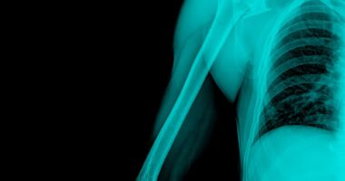 bone health, Gaucher