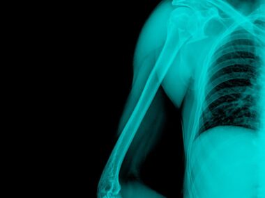 bone health, Gaucher