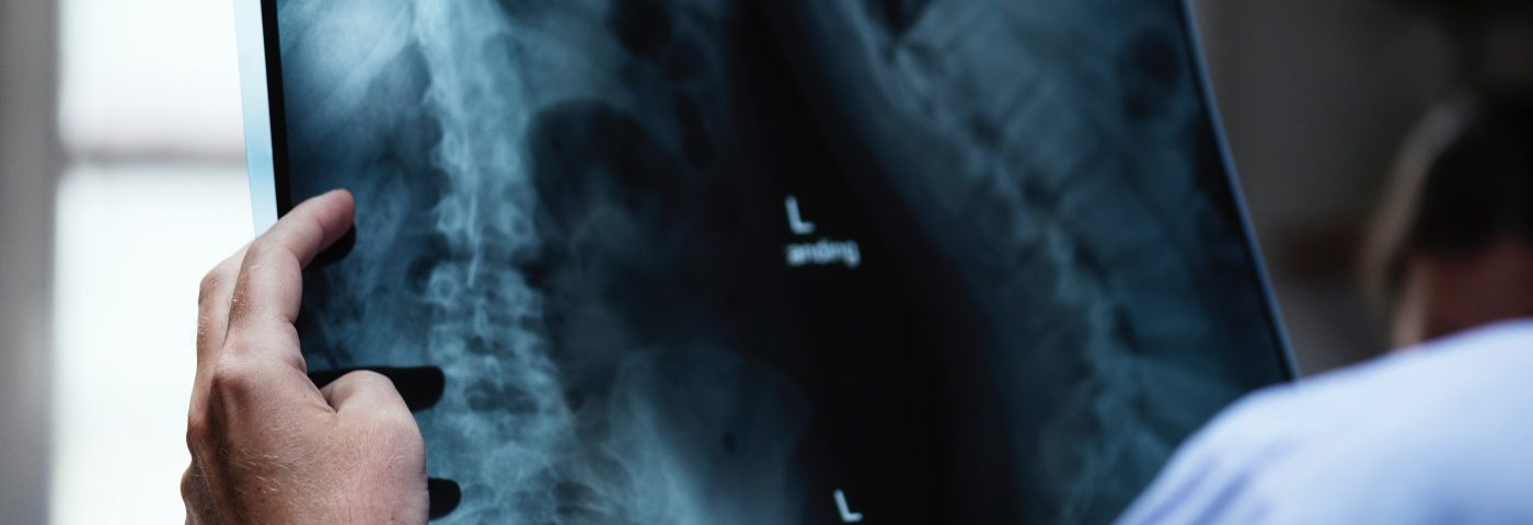 Gaucher-induced Spine Lesion Triggers Neurological Symptoms in Type 1 Disease, Case Report Says
